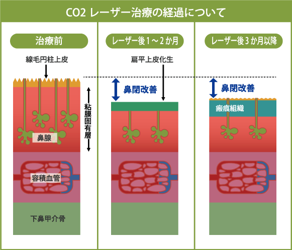 CO2レーザー治療の経過について